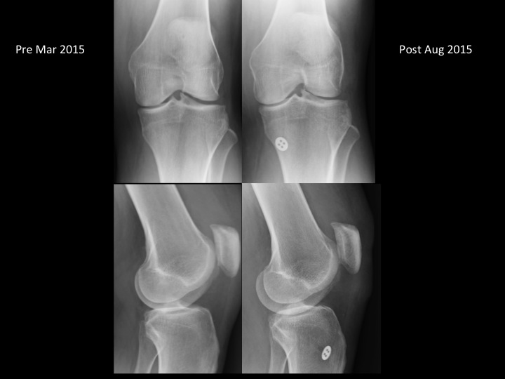 Figure 5 for case posterior root of medial meniscus ( RID2777 )